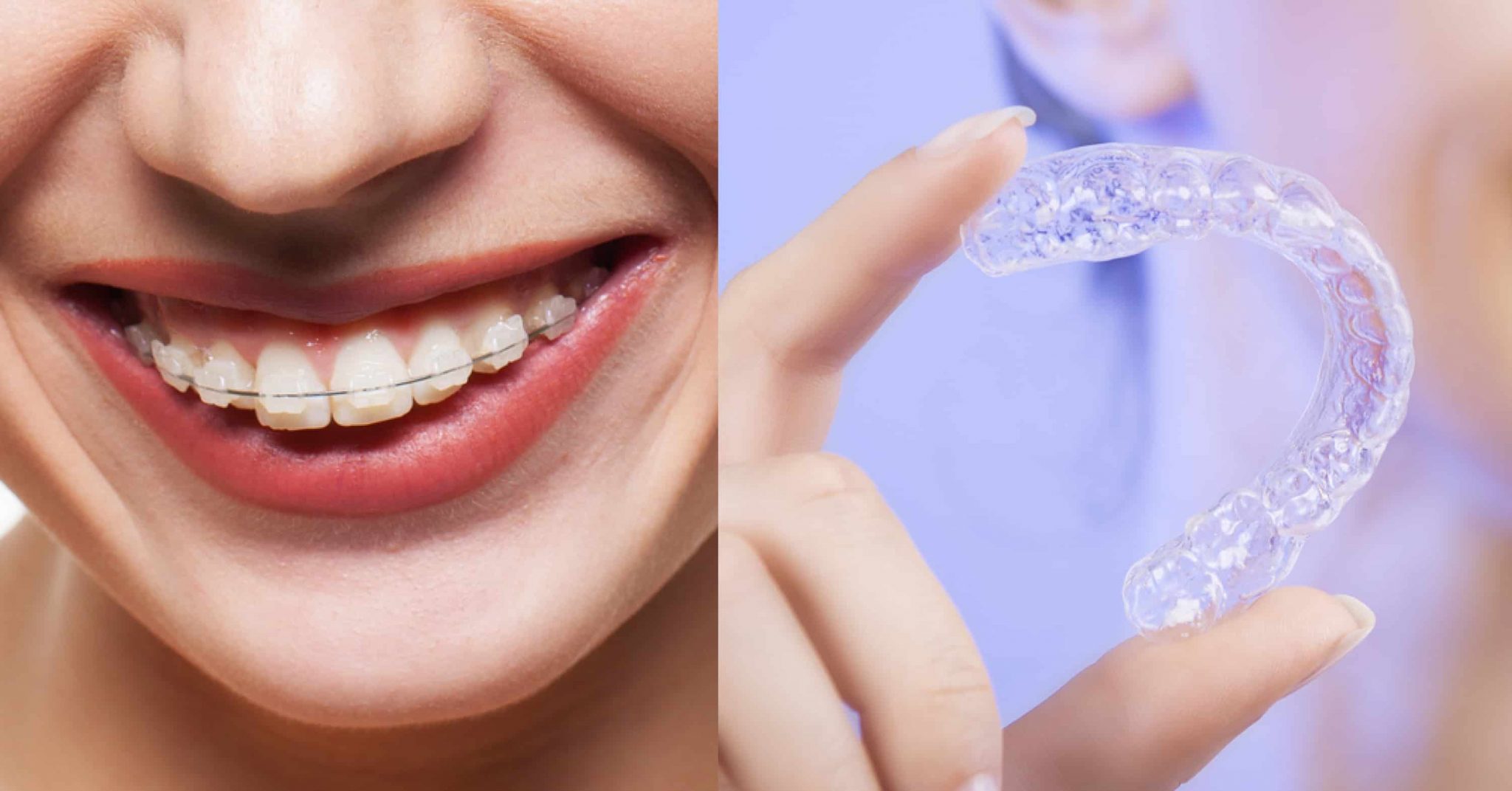Invisalign provider Breslau